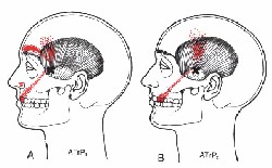 dolore dentale non odontogeno, miofascilae